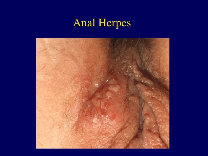 genital herpes anal Genital herpes anal